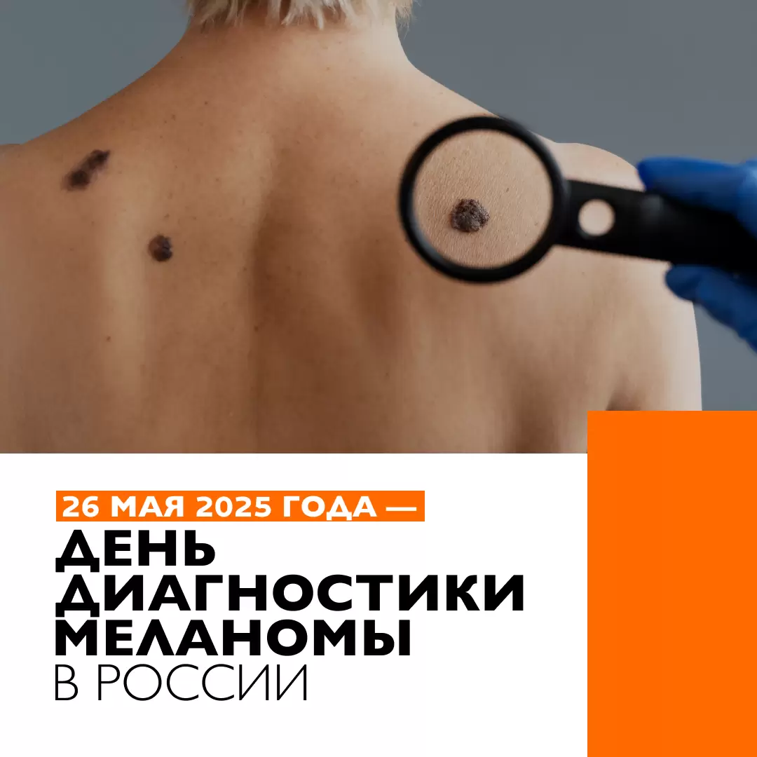ДЕНЬ ДИАГНОСТИКИ МЕЛАНОМЫ 